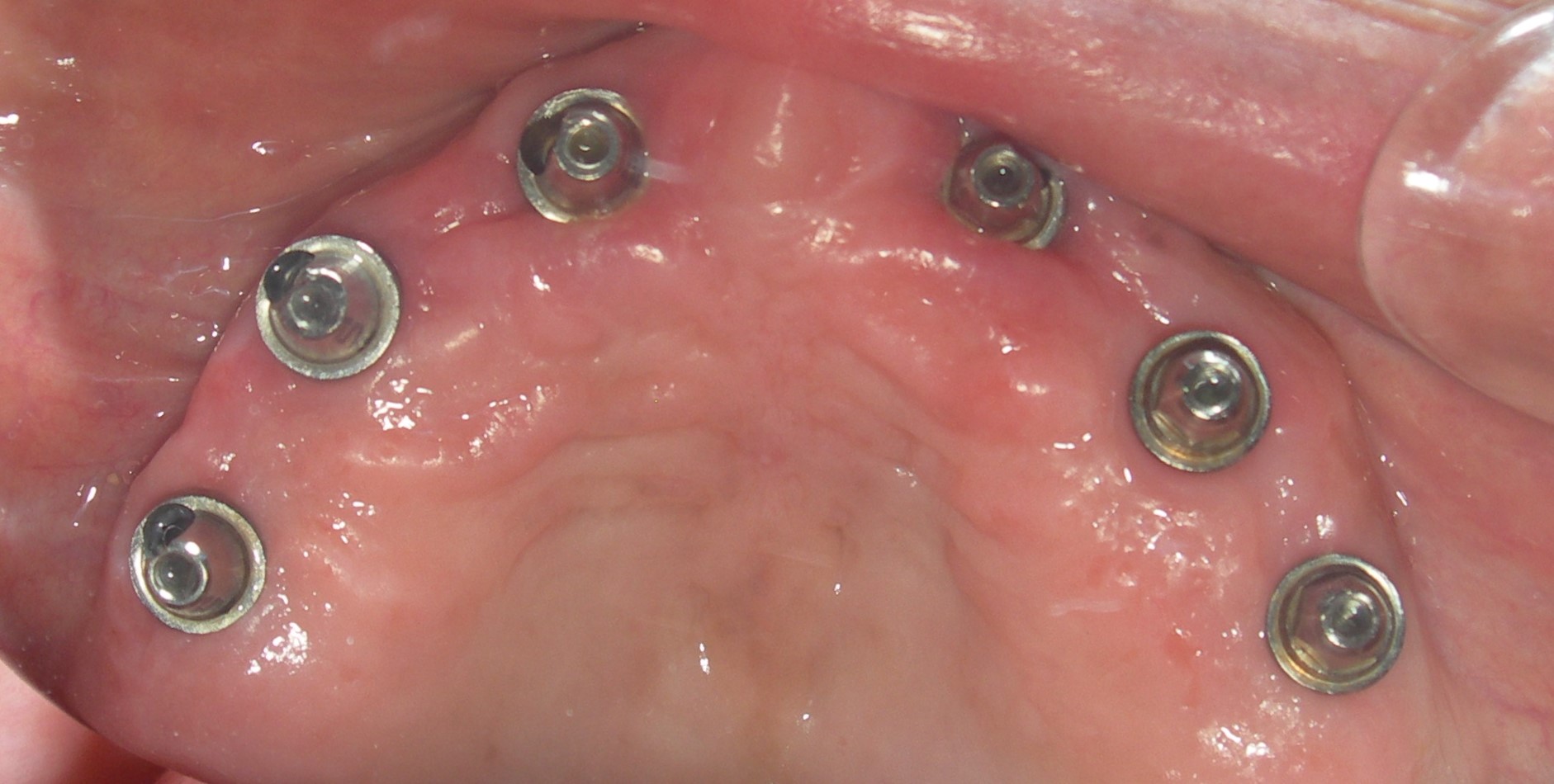 İmplant Vidalı Sistem Sonrası